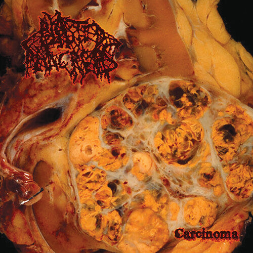 Blasted Pancreas - Blasted Pancreas - Carcinoma
